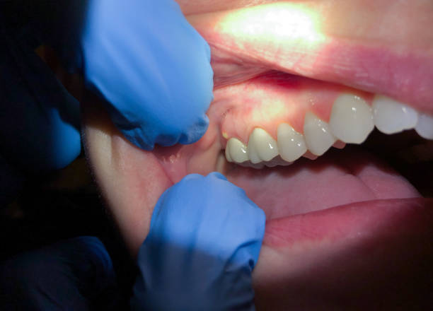 Best Emergency Dentist for Lost Fillings or Crowns in Spring Valley Village, TX